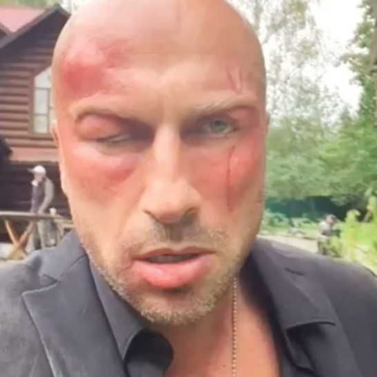 Дмитрий Нагиев шокировал поклонников своим внешним видом