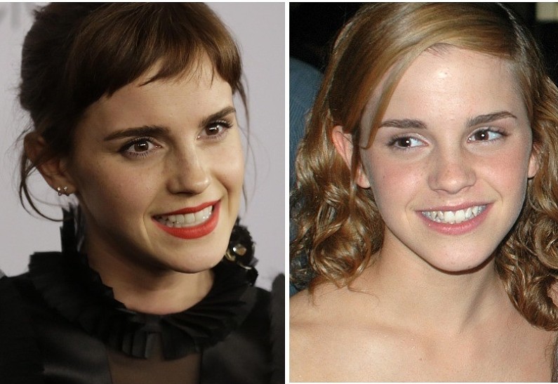 Звездные виниры: кто из знаменитостей перестарался в погоне за идеальной улыбкой, а чьи зубы выглядят идеально?