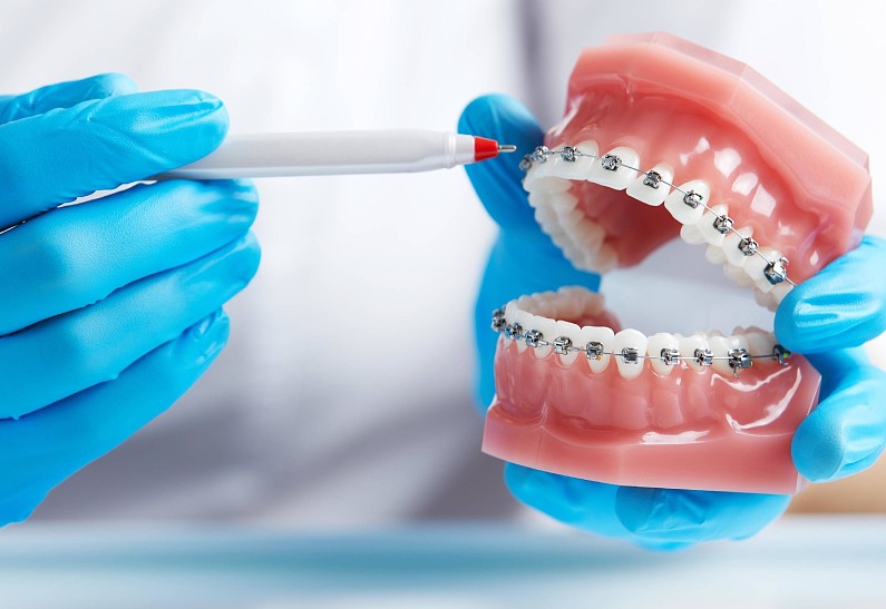 Всё о брекетах: как создать идеальную улыбку?